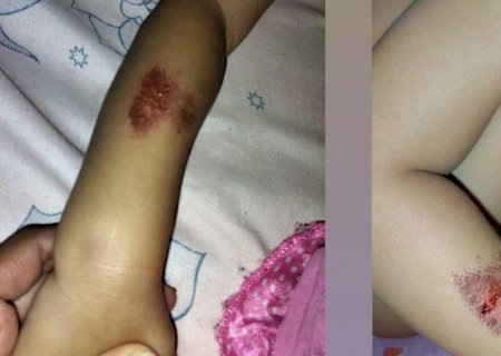 Bebê sofre queimadura em Emei e professoras dizem que menina foi mordida por outra criança