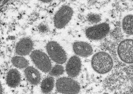 Distrito Federal tem primeiro caso de varíola dos macacos>