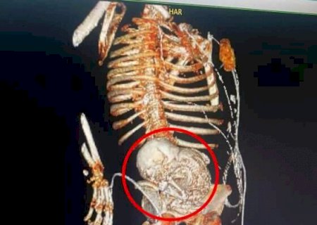 “Grávida por 5 décadas”: paciente descobre feto mumificado há 56 anos no útero