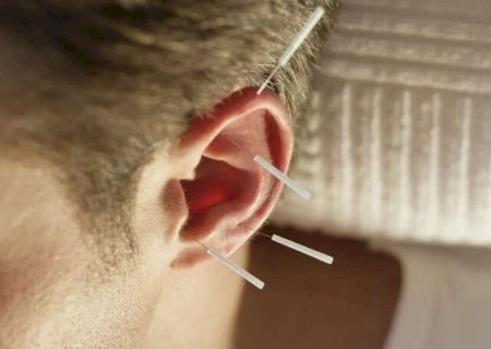 Nutricionistas passam a poder aplicar acupuntura como apoio ao tratamento