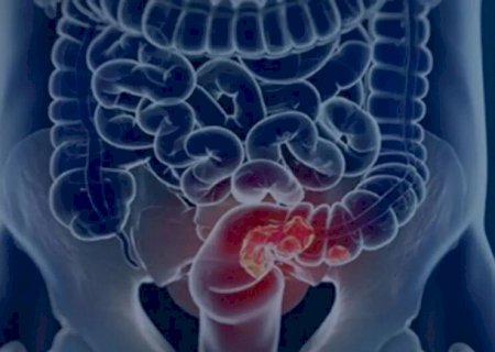 SUS adota teste de fezes para ampliar rastreio de c&acirc;ncer no intestino>